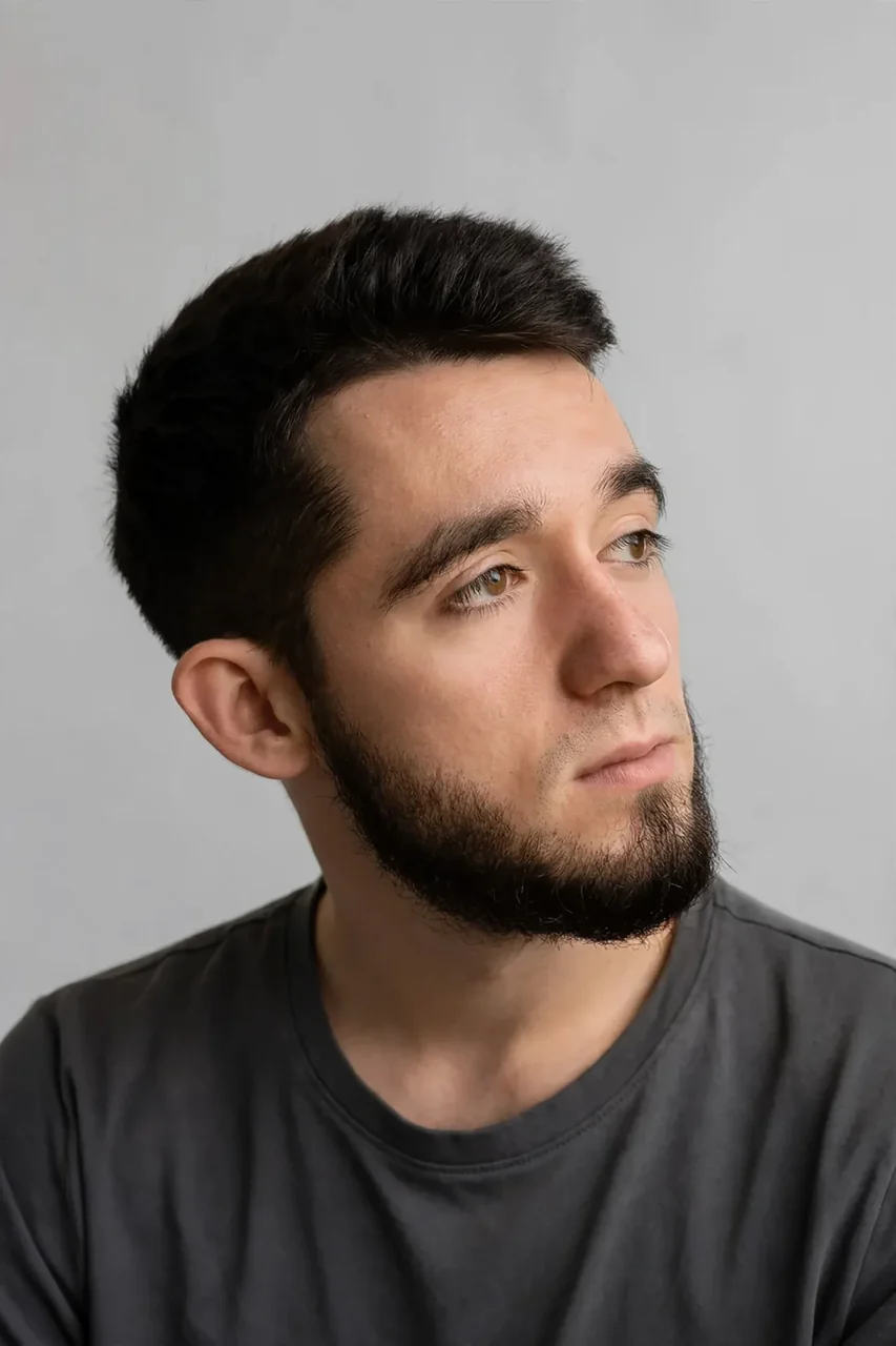 After: Beard transplant · cheeks