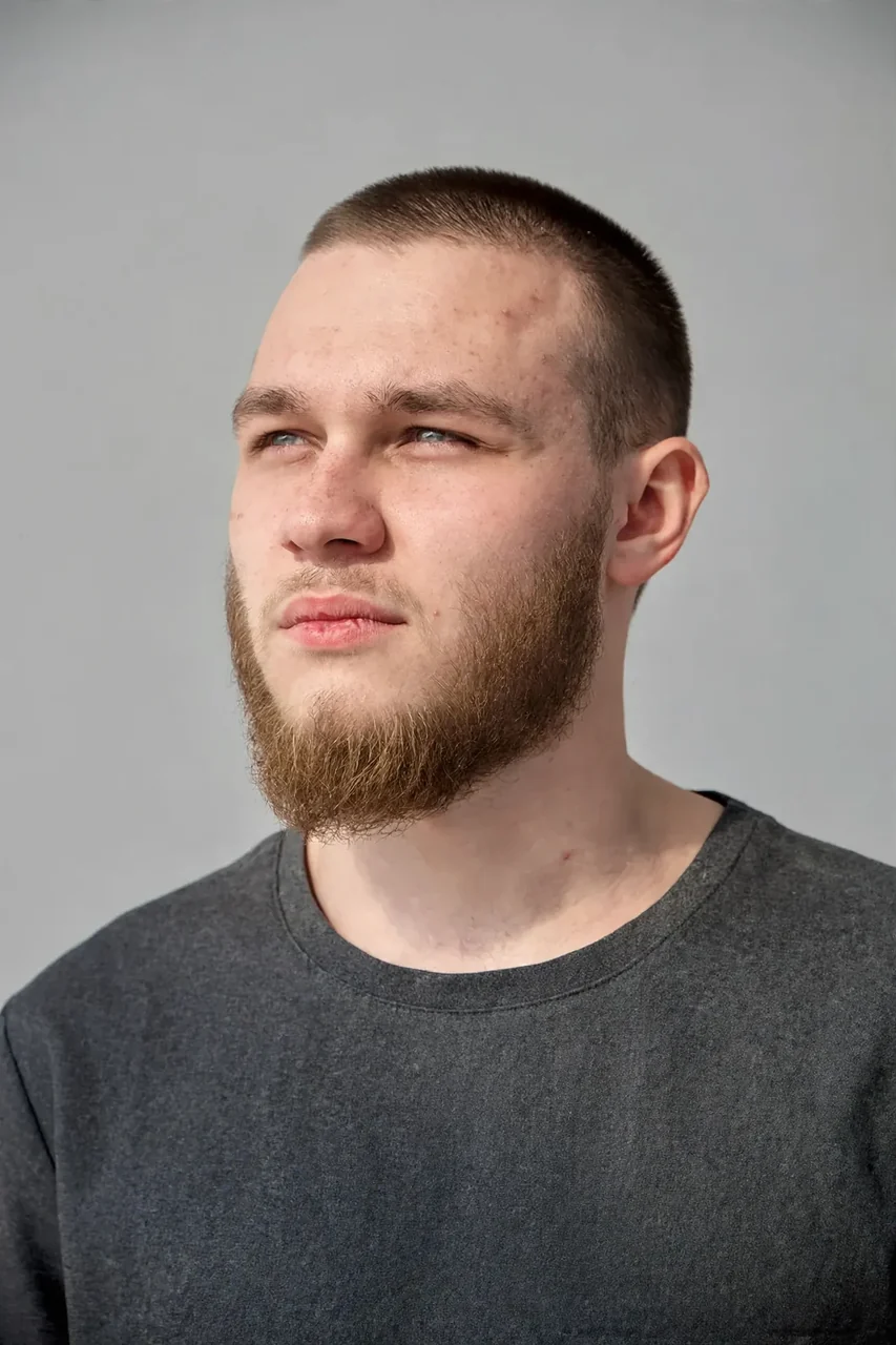 After: Beard transplant · full beard