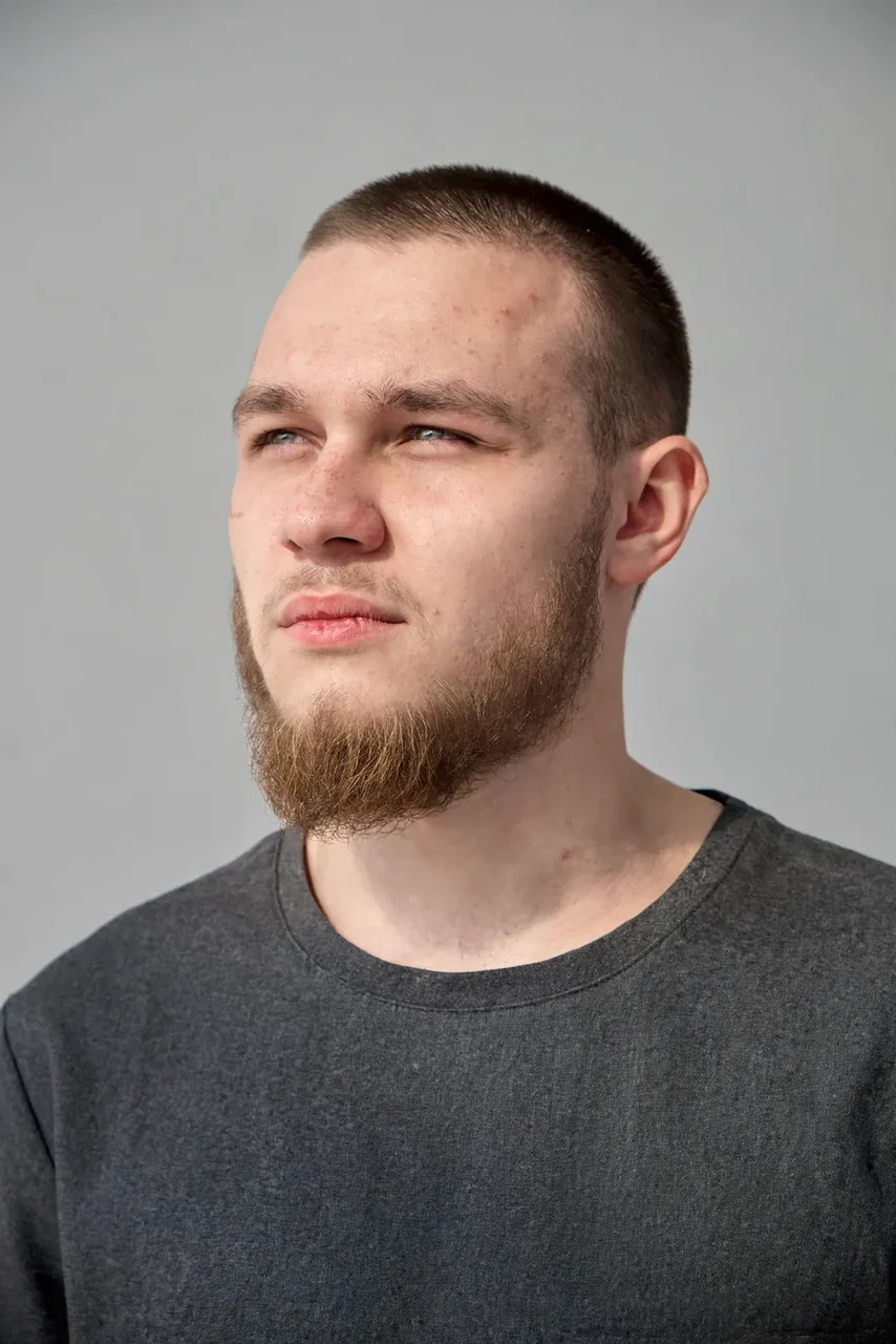 Before: Beard transplant · full beard
