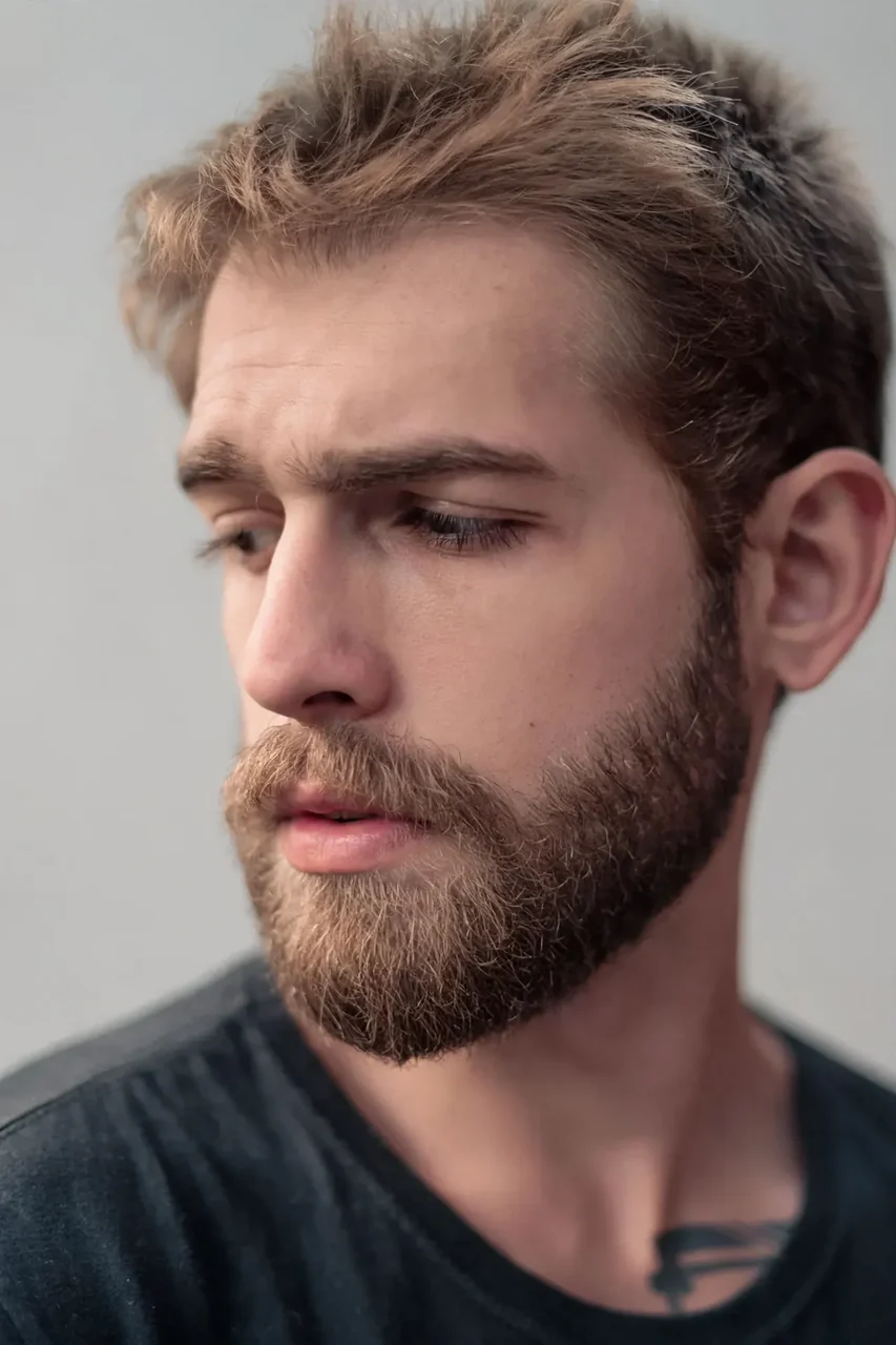 After: Beard transplant