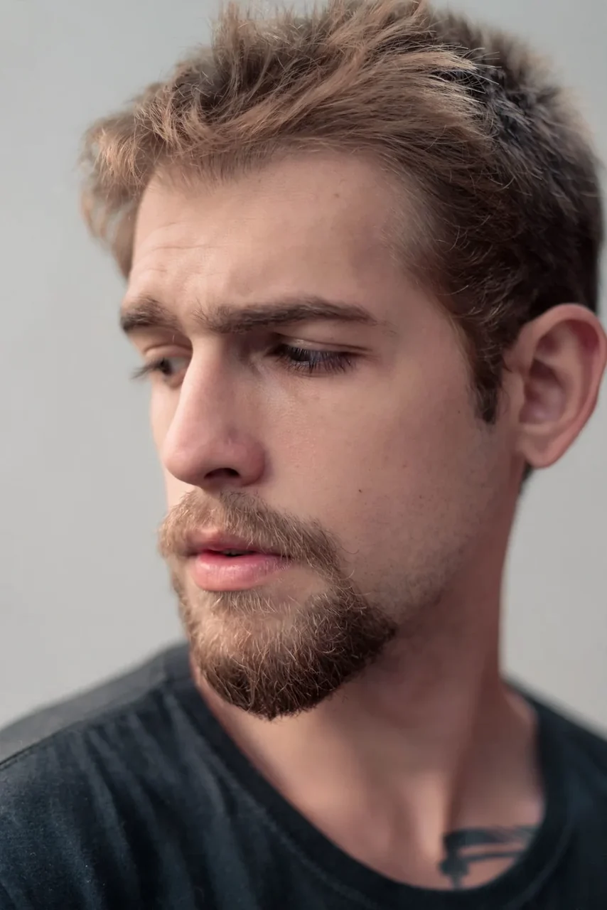 Before: Beard transplant