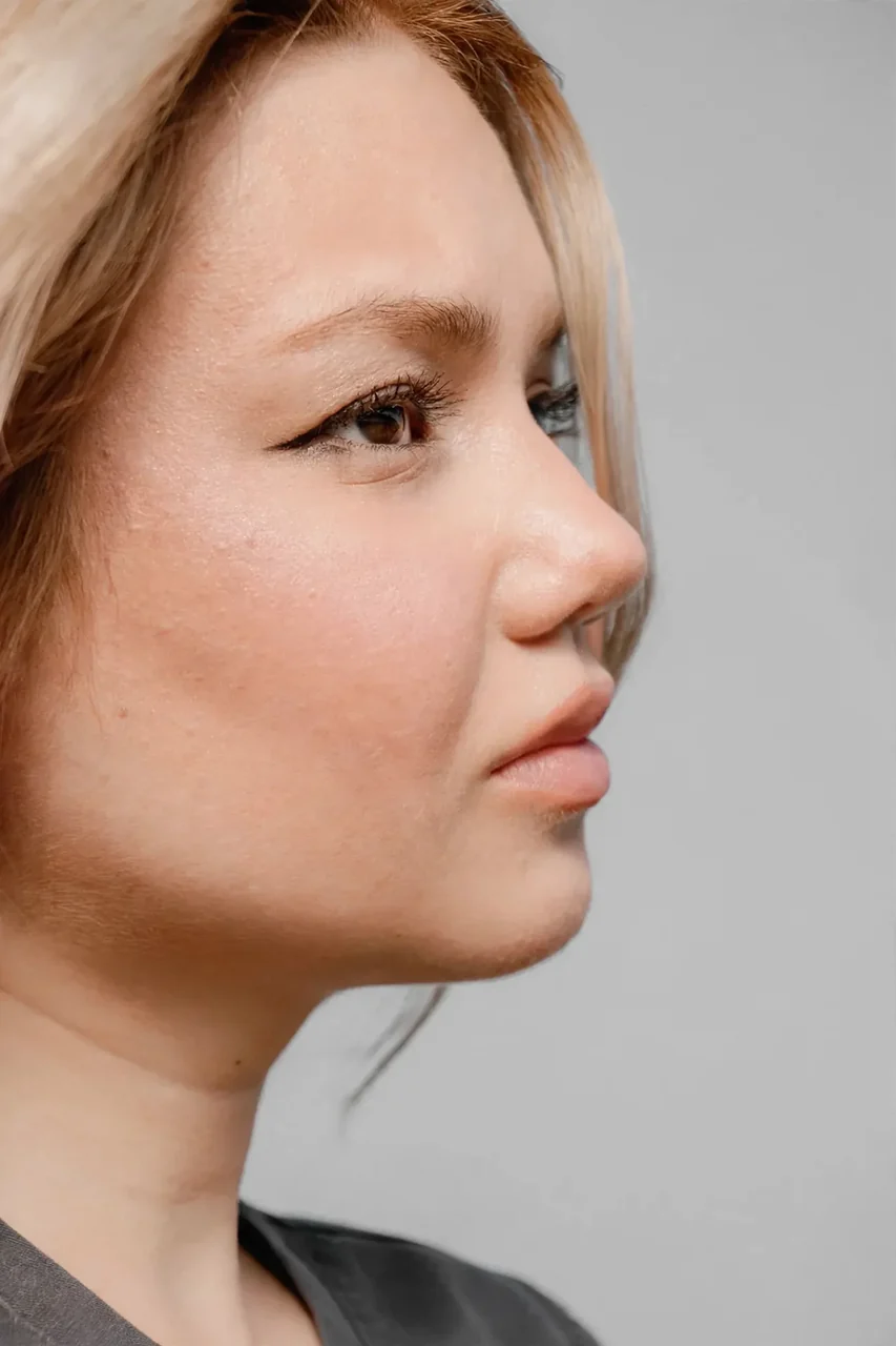 After: Buccal fat removal