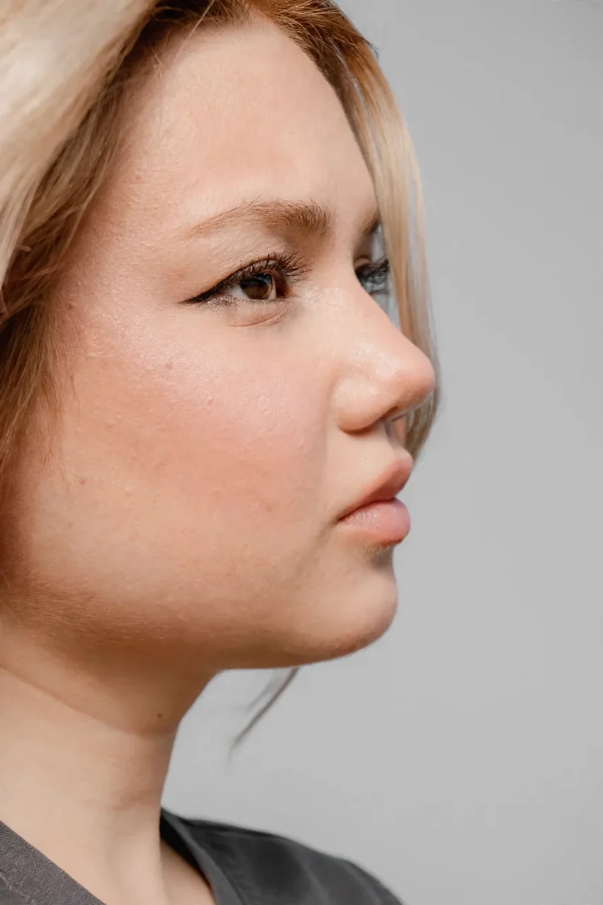 Before: Buccal fat removal