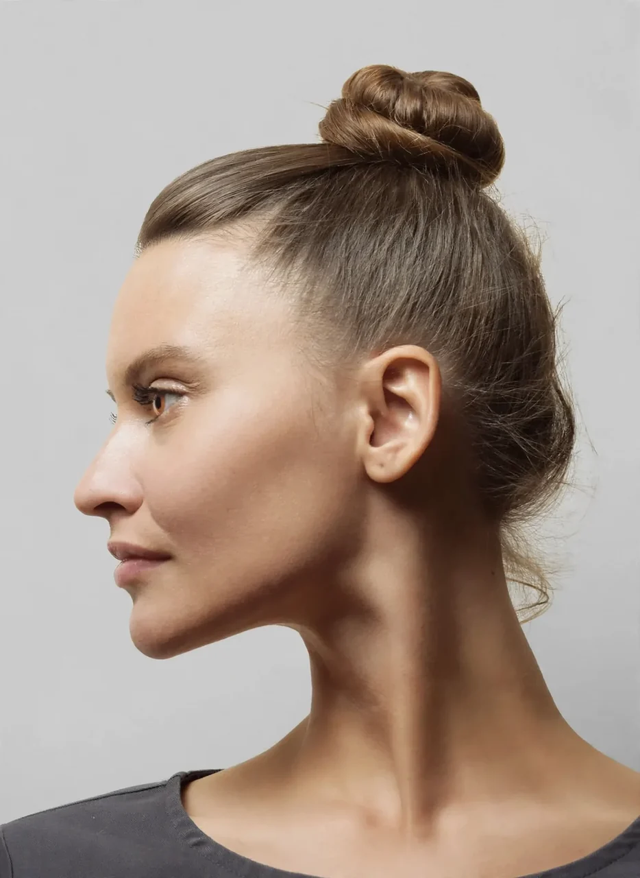 After: Chin and jawline filler · profile