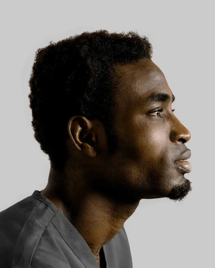 Before: Chin filler · men · profile