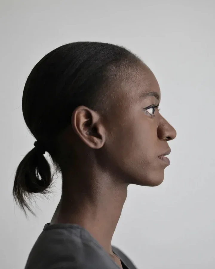 Before: Chin filler, profile