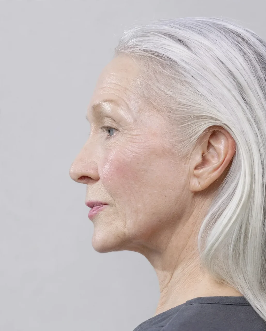 After: Face and neck lift · profile