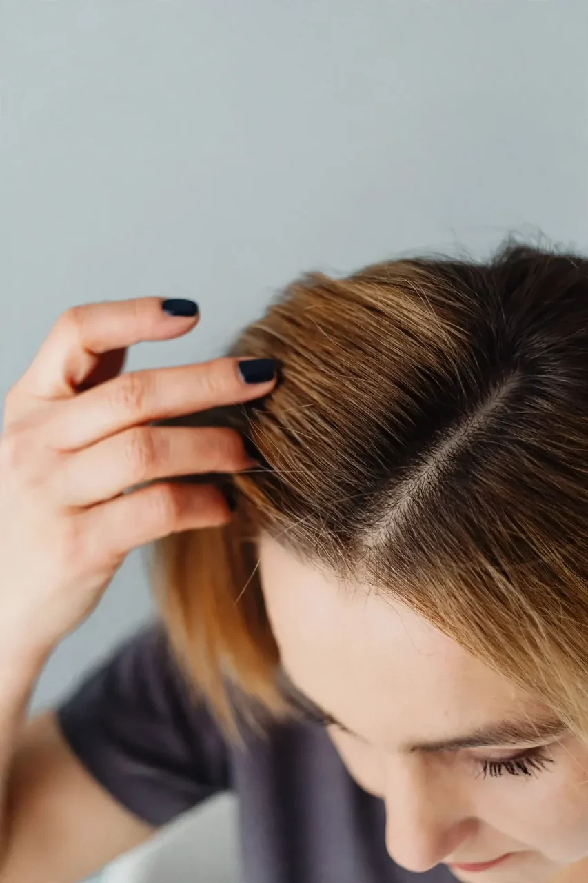 After: Female hair loss · top view
