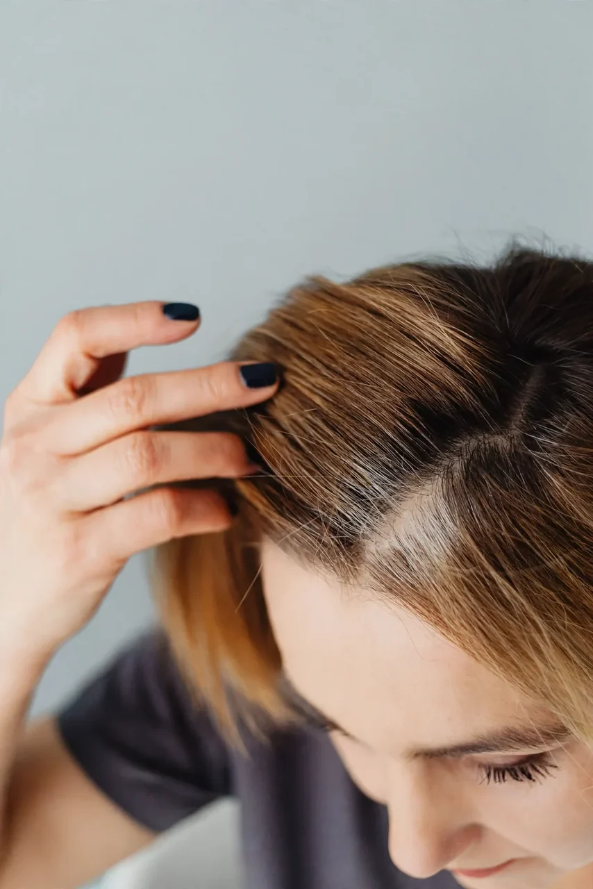 Before: Female hair loss · top view