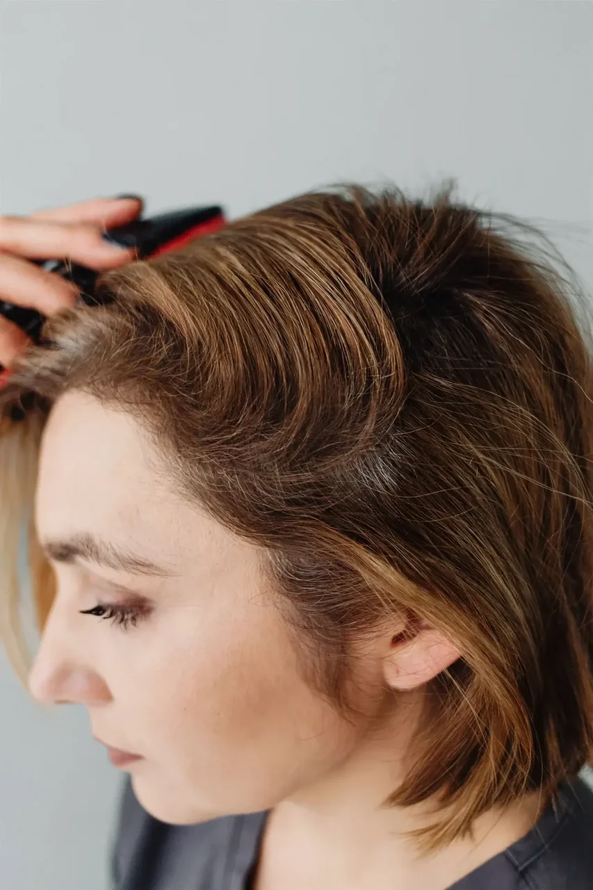 After: Female hair loss · temples
