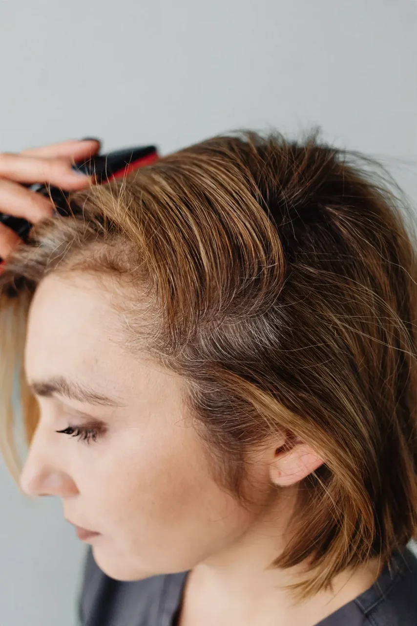 Before: Female hair loss · temples