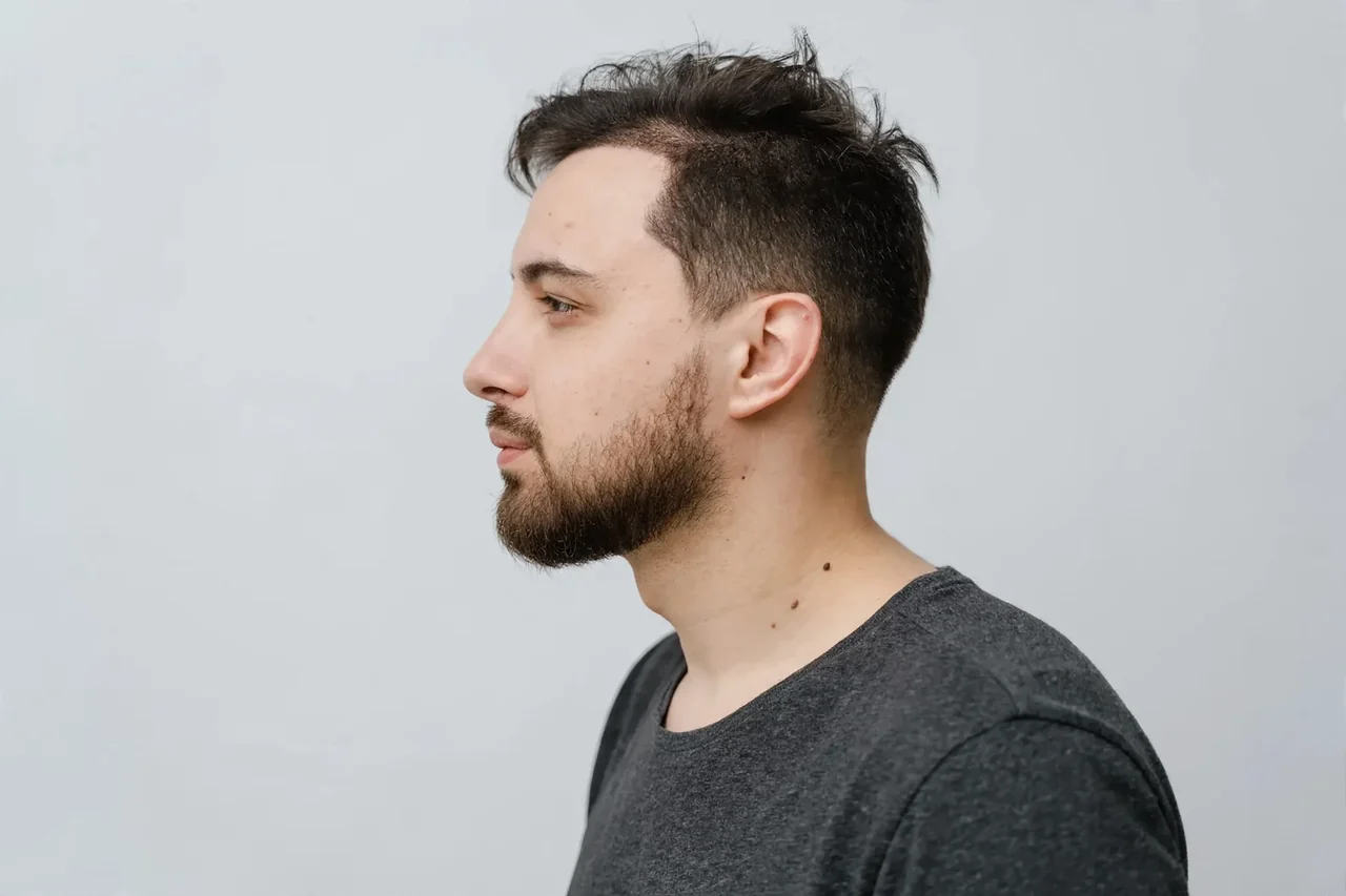 After: Hair transplant (FUE) · temple recession