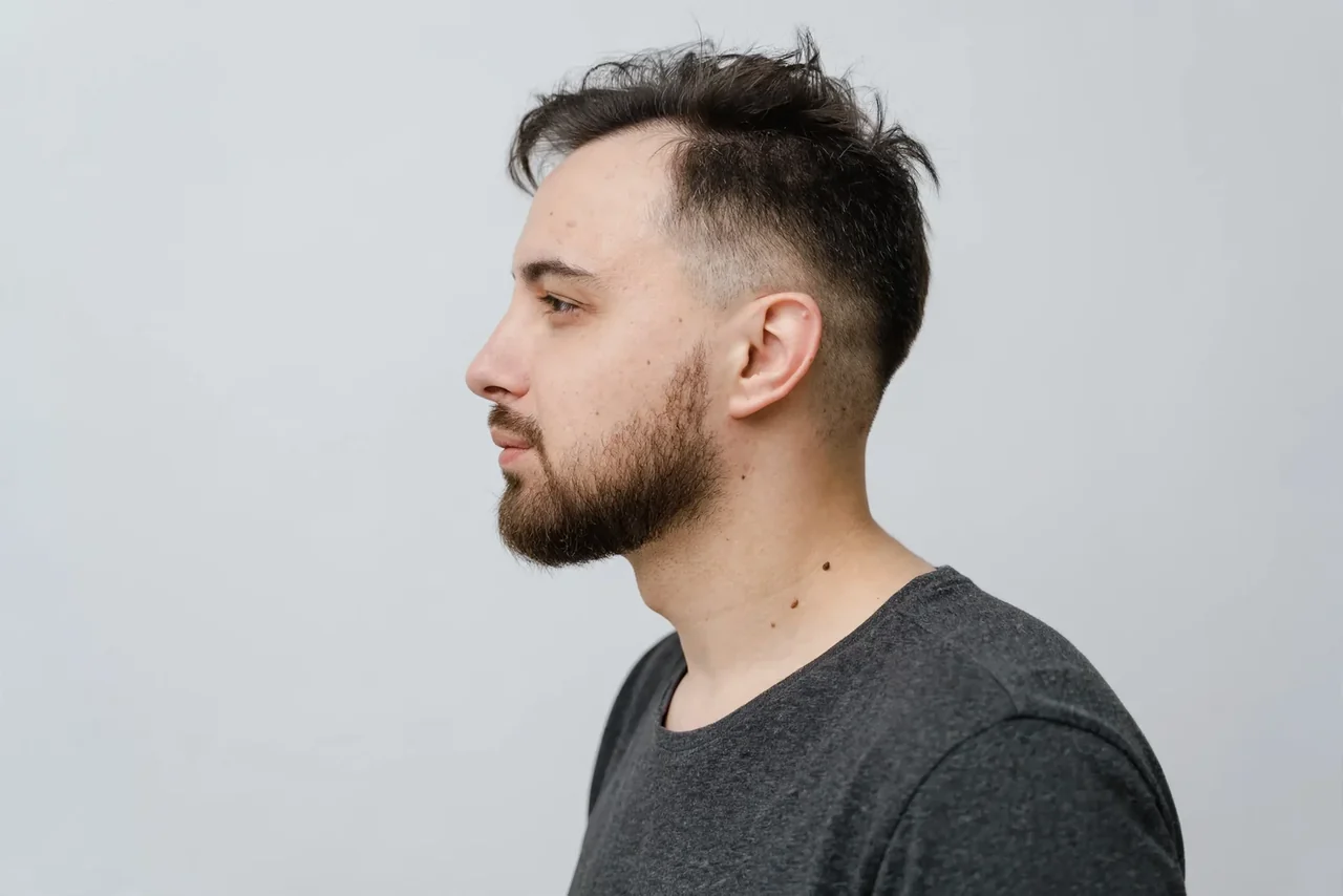 Before: Hair transplant (FUE) · temple recession