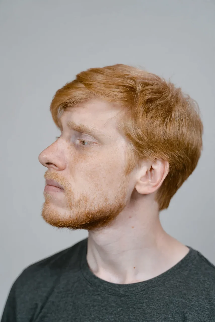 Before: Jawline and chin filler