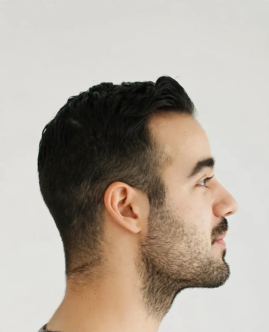 After: Jawline filler · profile