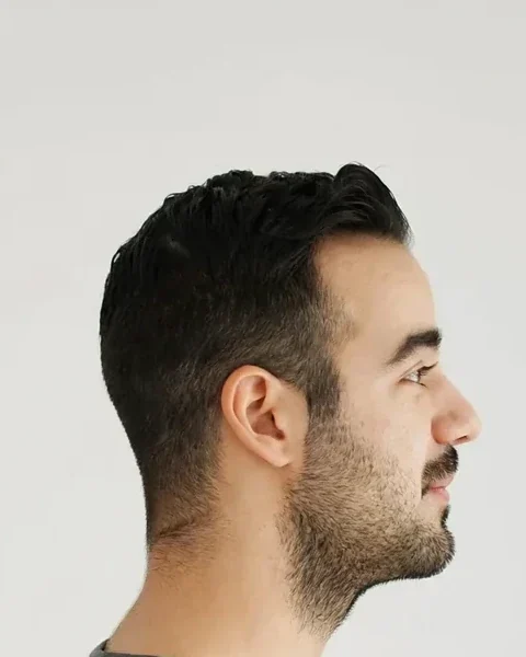 Before: Jawline filler · profile