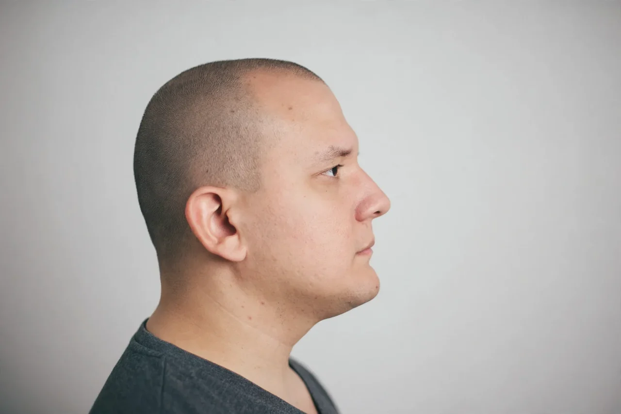 Before: Jawline filler