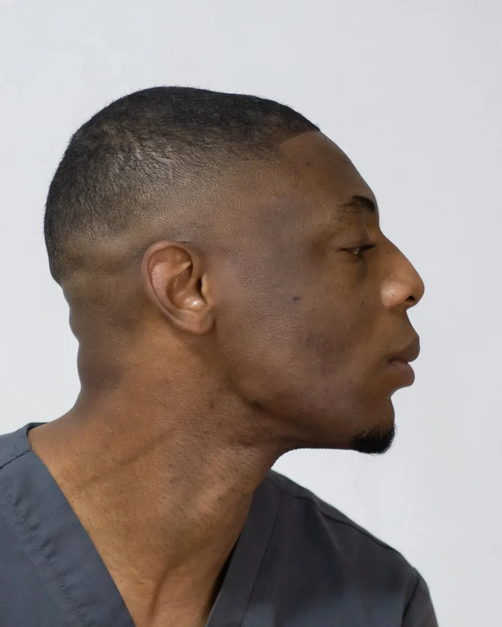 After: Jawline contouring