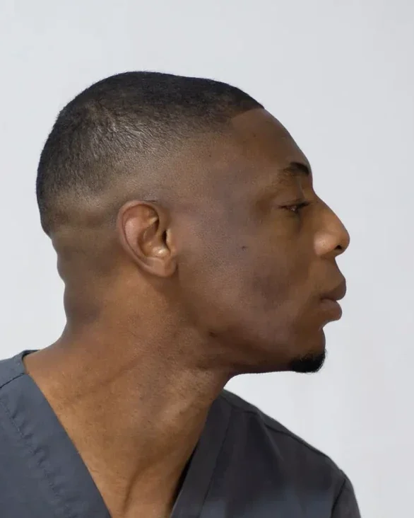 Before: Jawline contouring