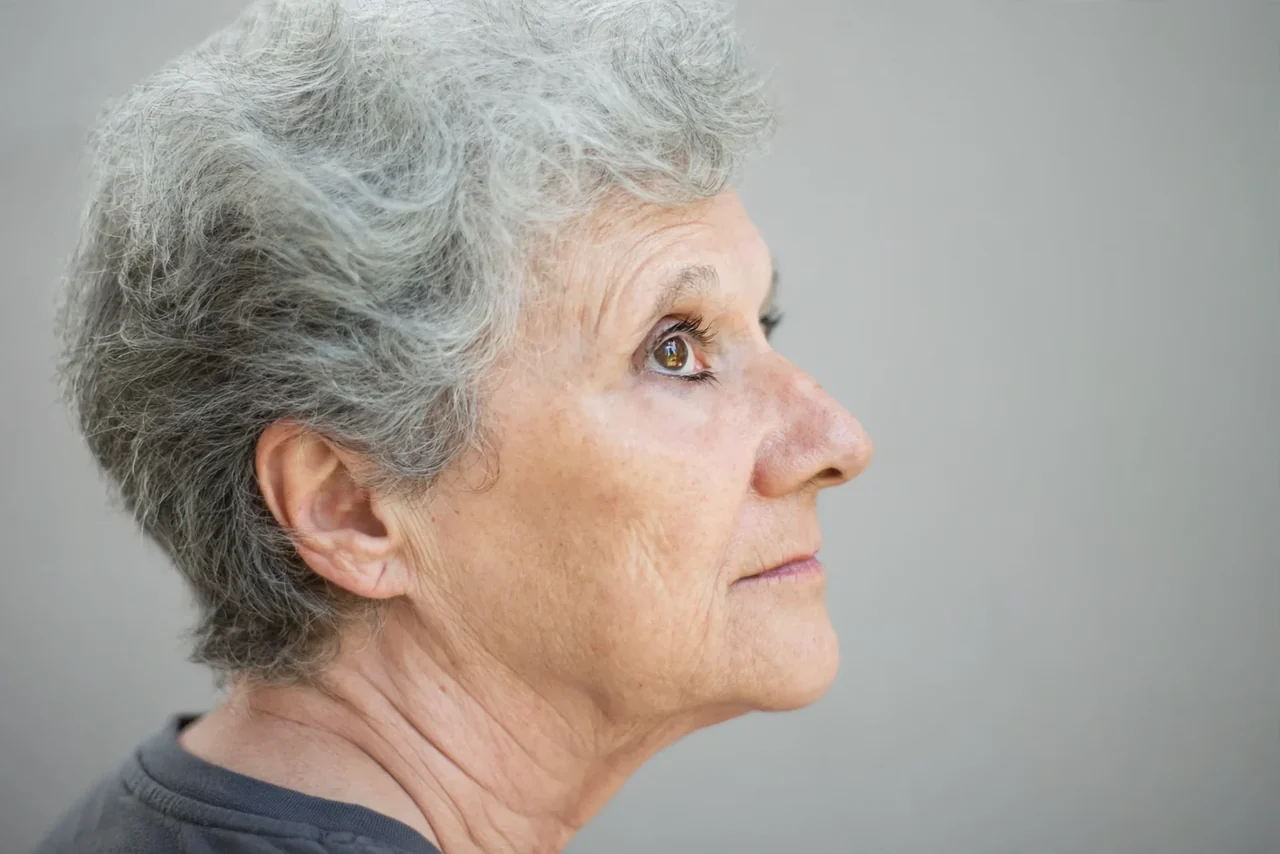 Before: Lip filler · perioral lines