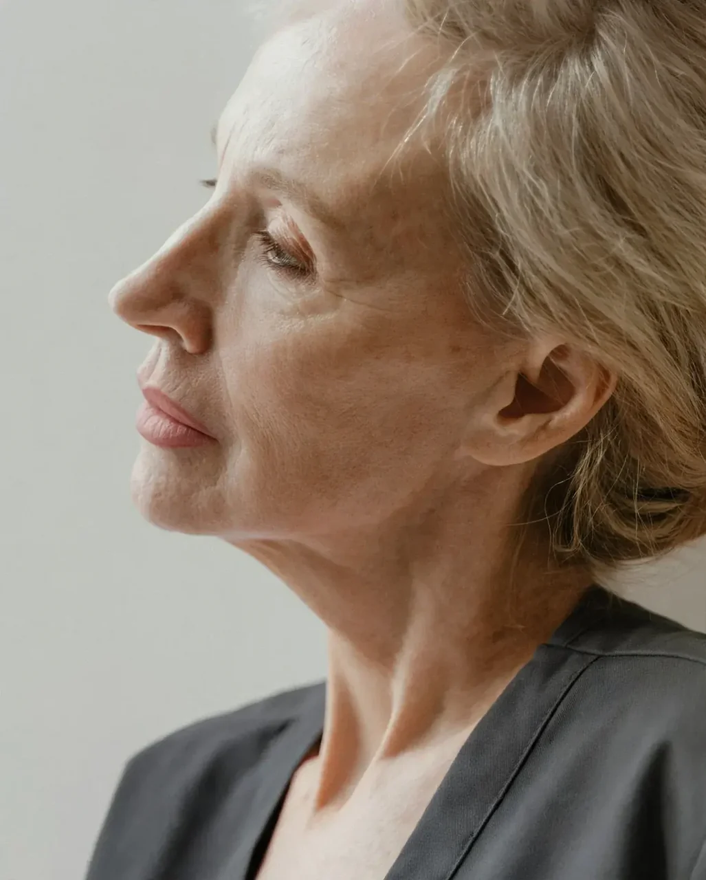 After: Lip filler · thin lips · 1 ml