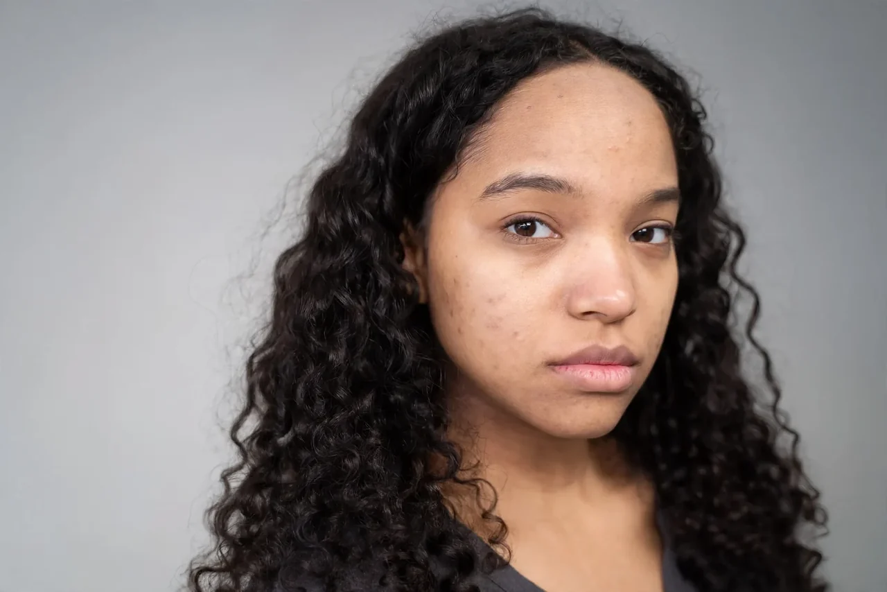 Before: Microneedling · acne marks