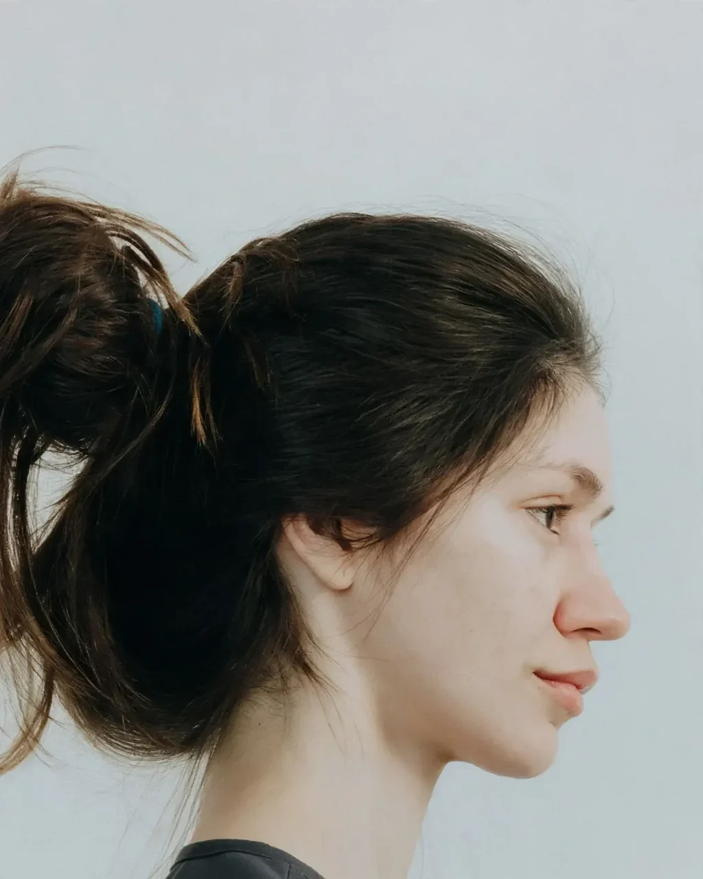 After: Liquid rhinoplasty · nose filler