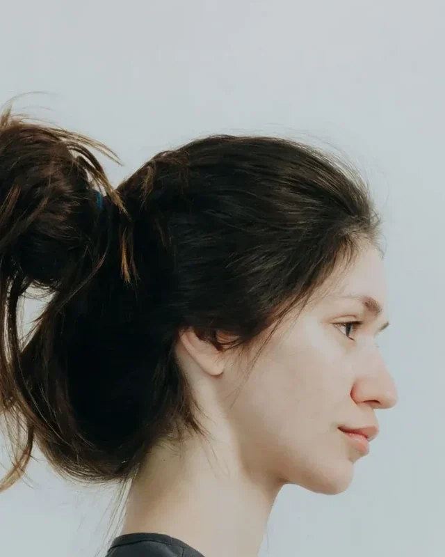 Before: Liquid rhinoplasty · nose filler