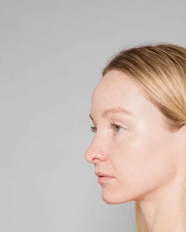 Before: Rhinoplasty · profile