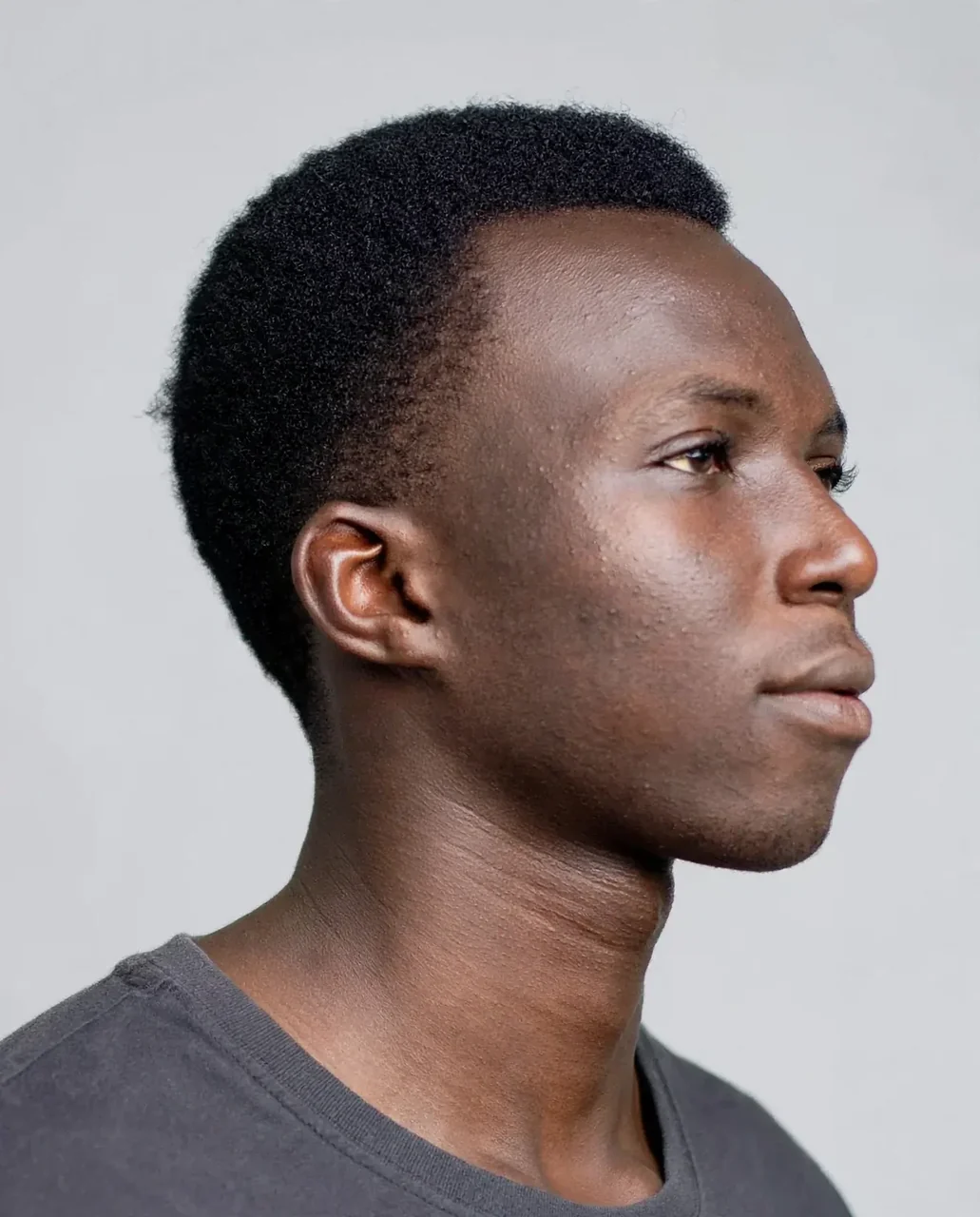 After: Rhinoplasty · width