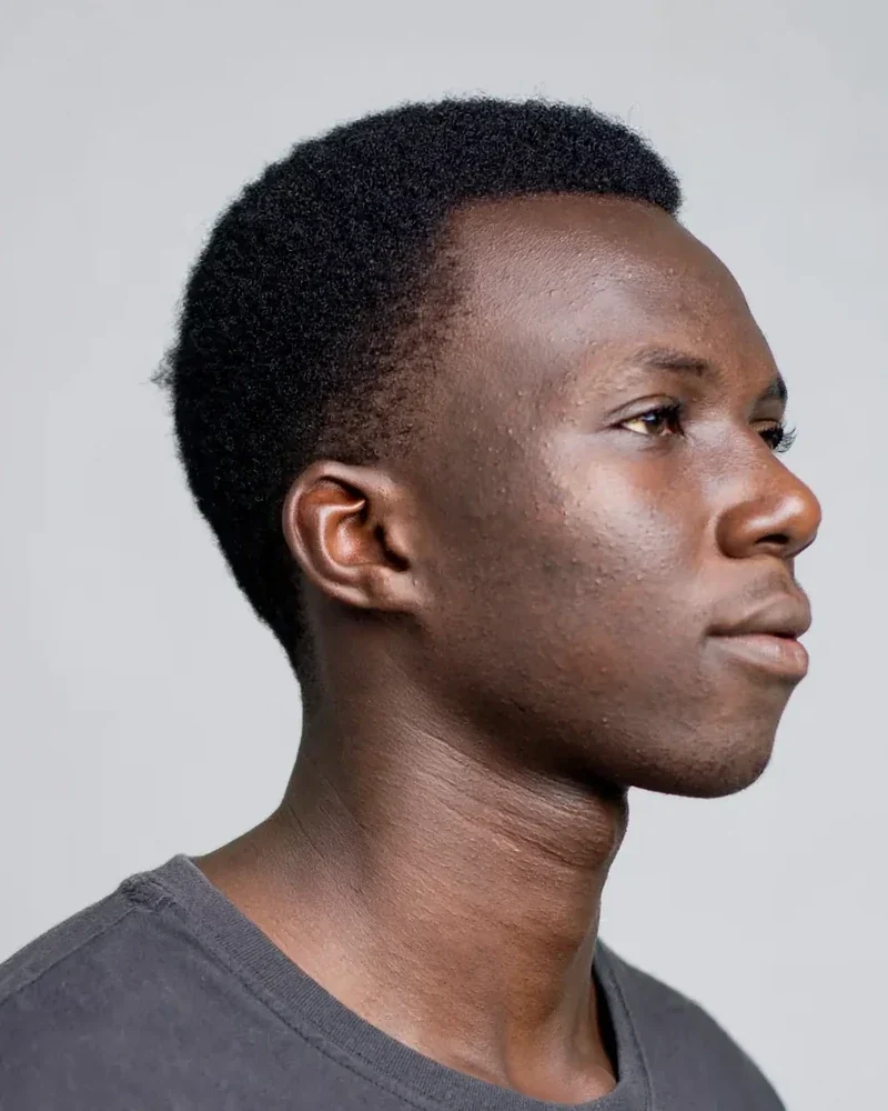 Before: Rhinoplasty · width
