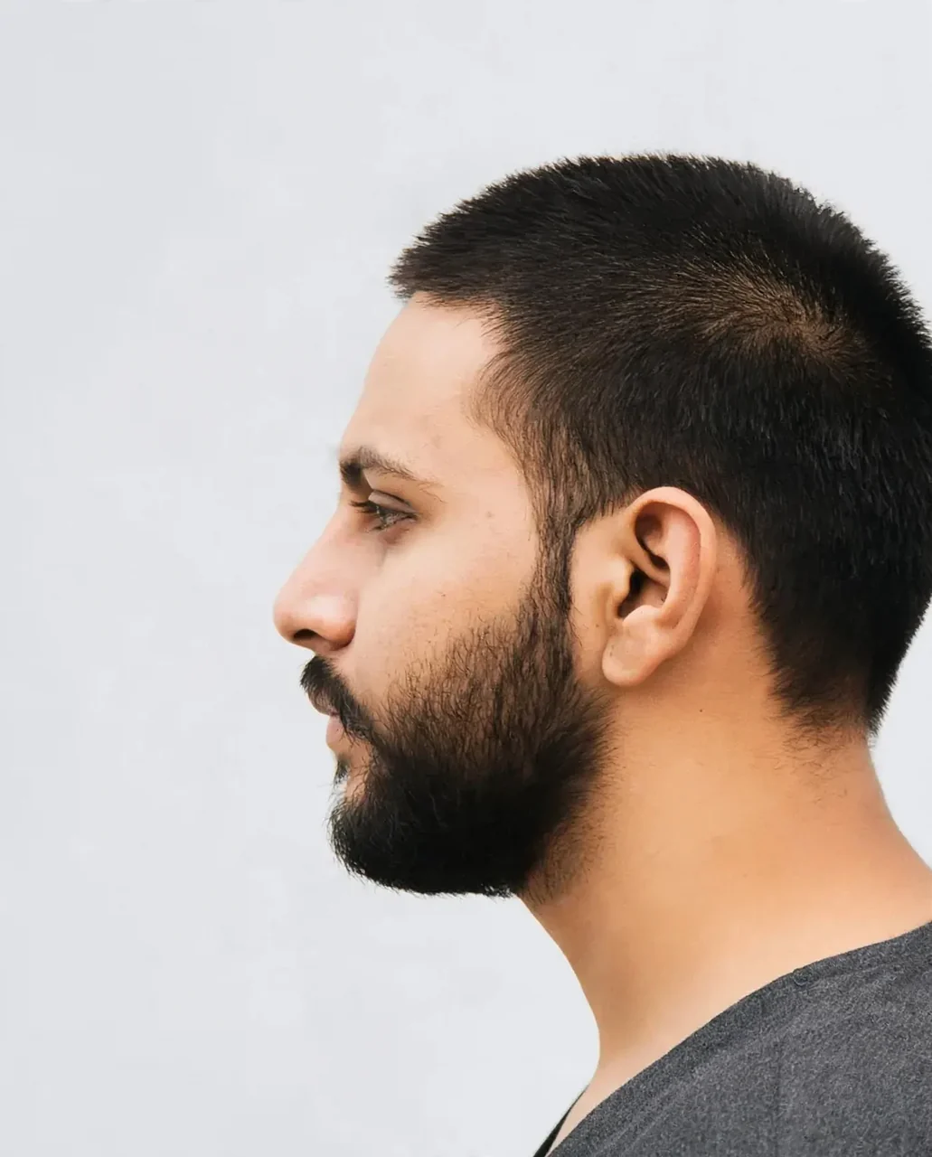 After: Rhinoplasty · bridge
