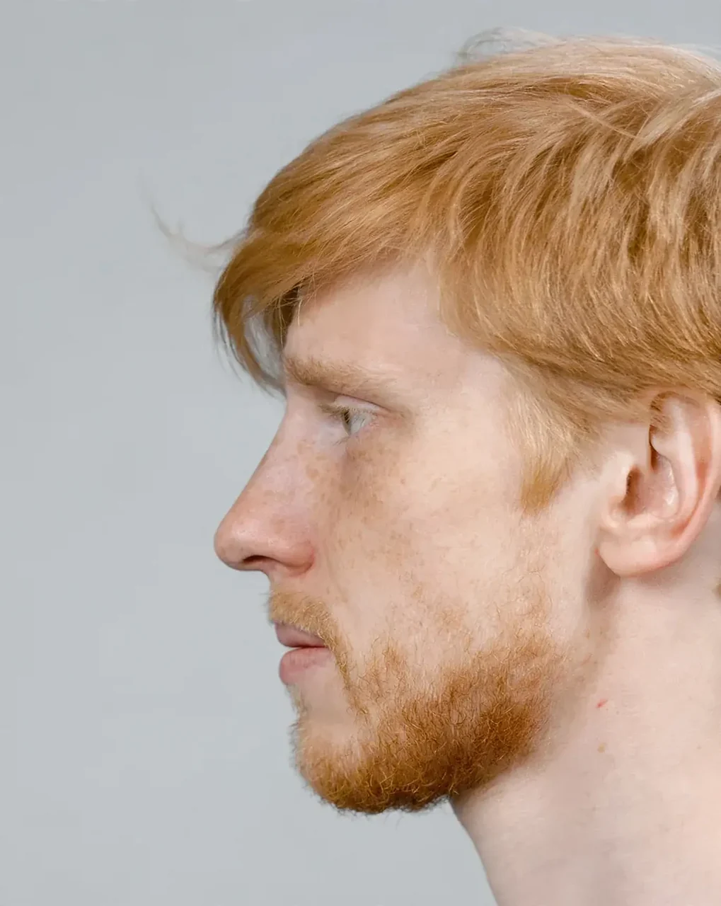 After: Rhinoplasty · men