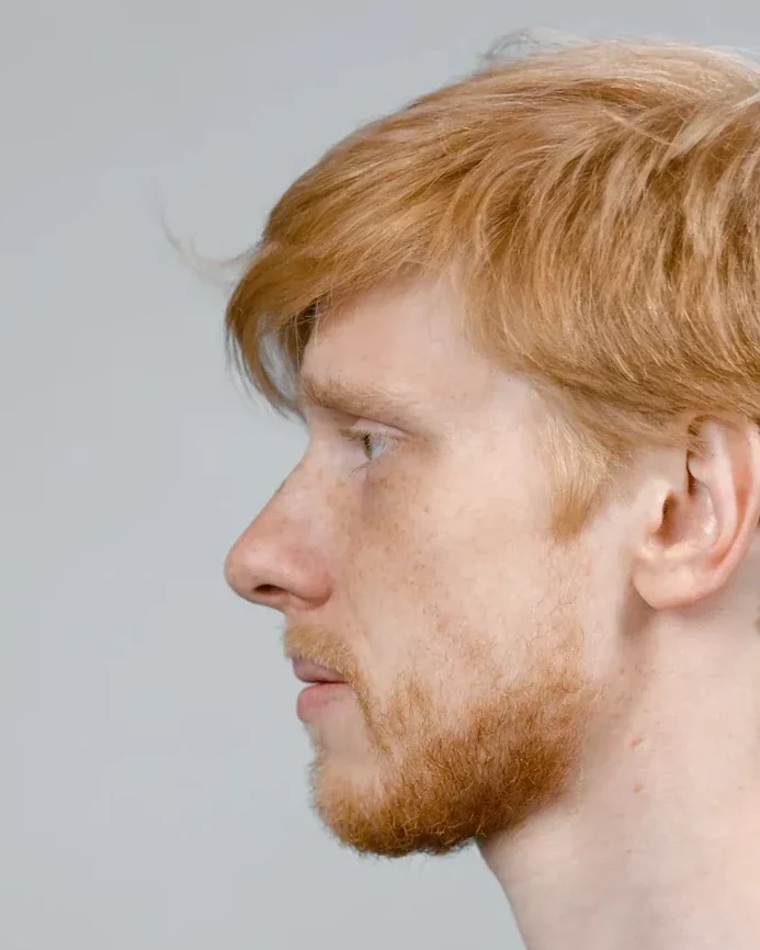 Before: Rhinoplasty · men