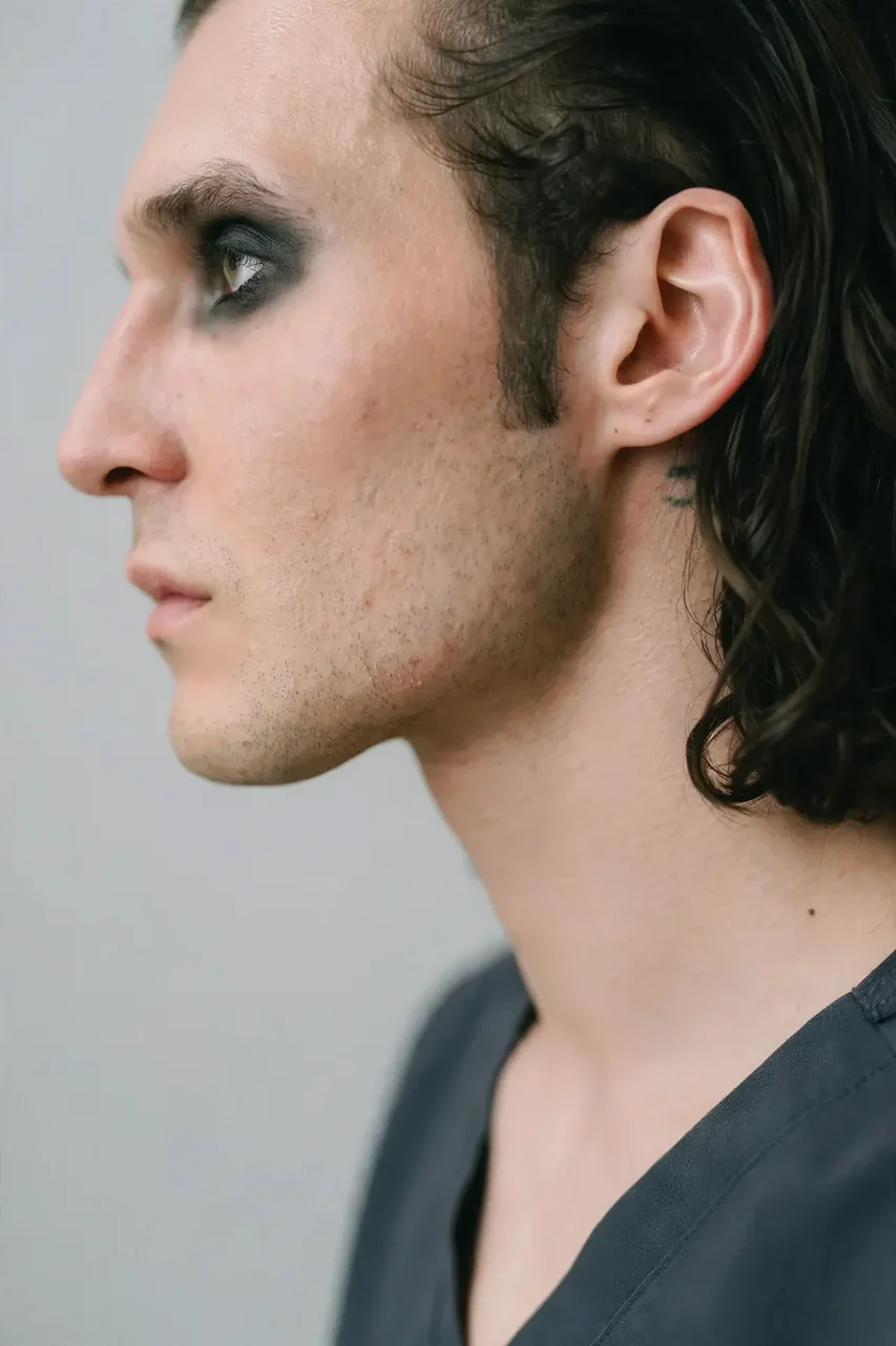After: Rhinoplasty · bridge and tip