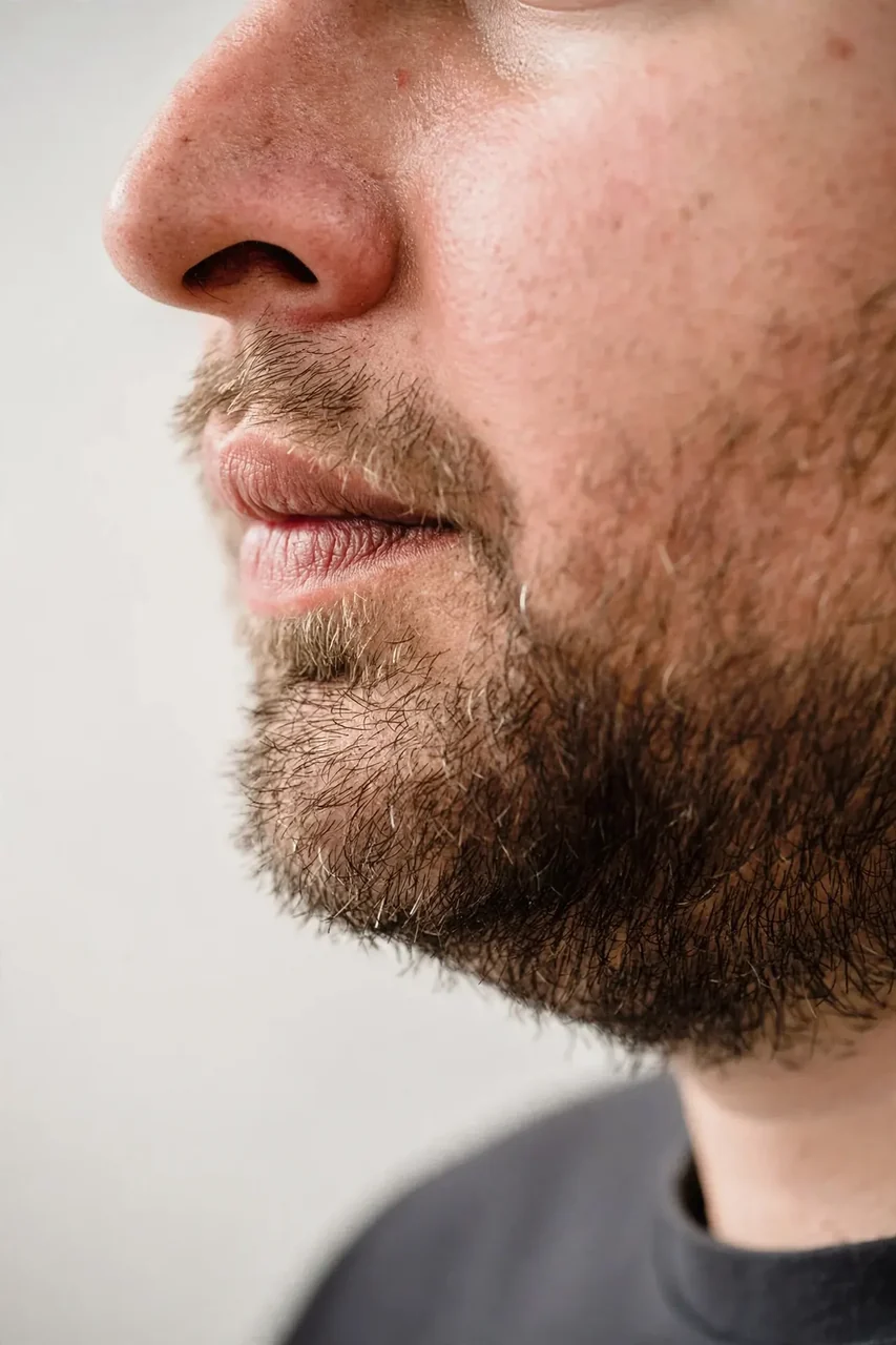 After: Rhinoplasty · tip refinement