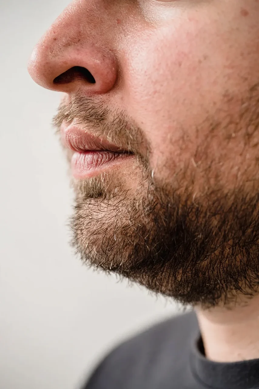 Before: Rhinoplasty · tip refinement